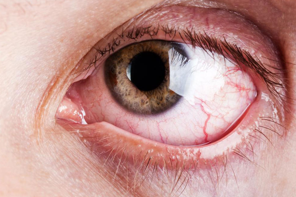 What are the common and rare symptoms of Graves’ disease