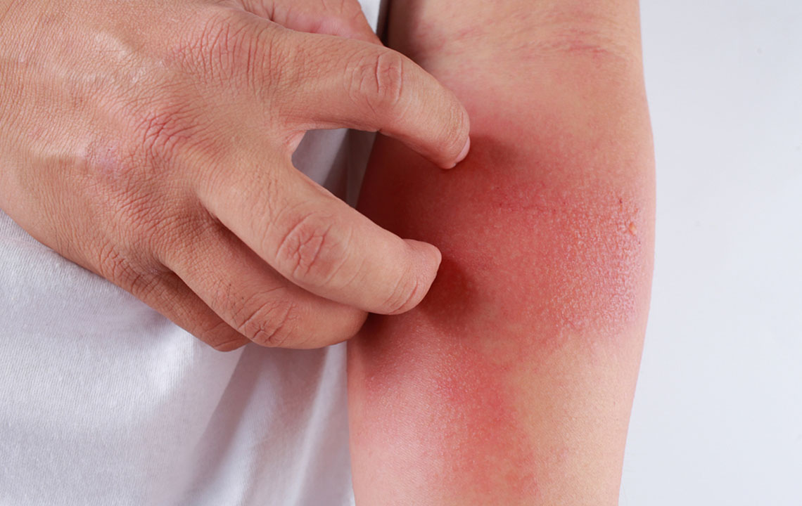 Here’s How to Identify a Skin Rash